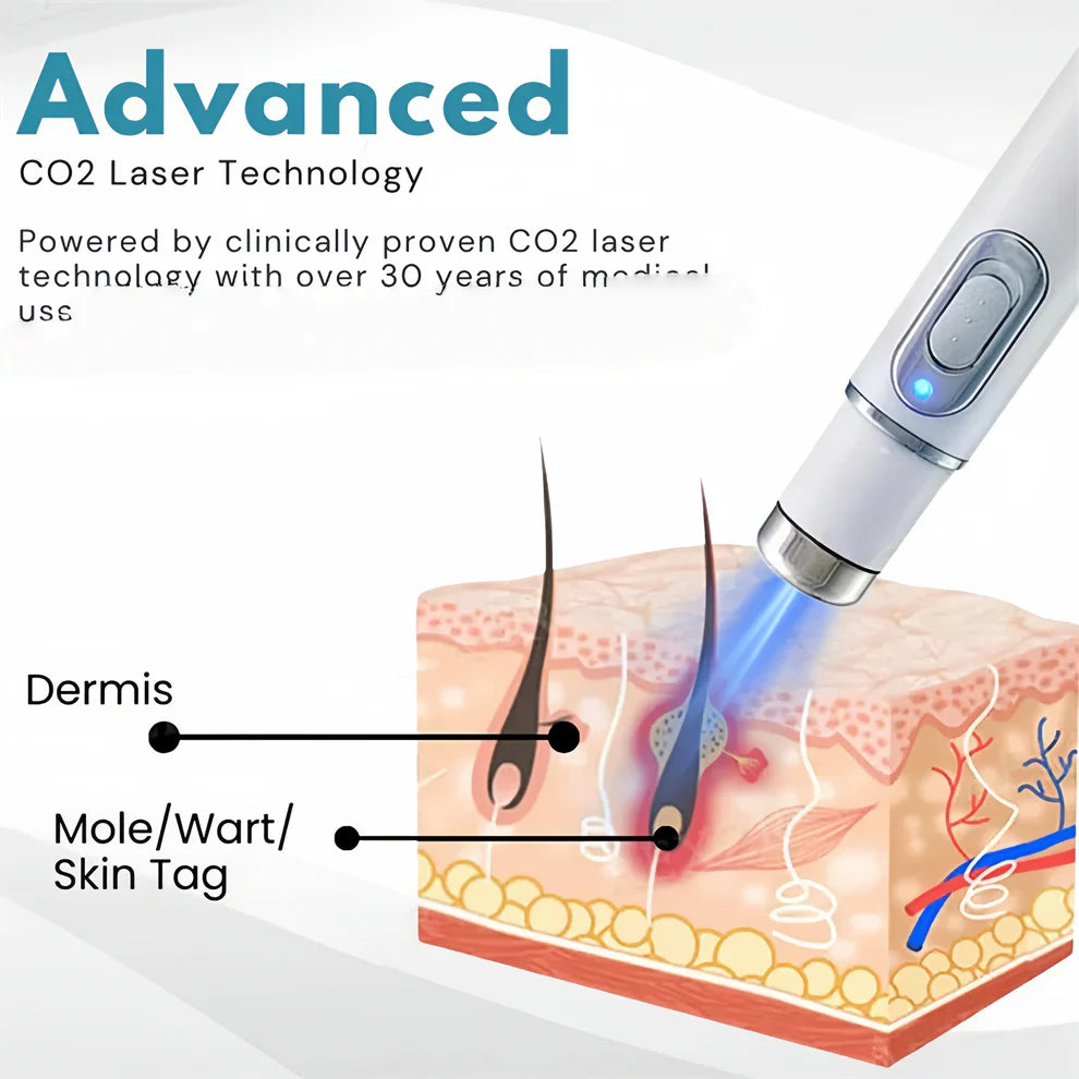 Blue Light Acne Treatment Device (Non-Invasive Acne Laser Pen with Heating No Side Effect)